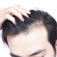 هل يمكن أن يتسبب نقص فيتامين د في تساقط الشعر؟